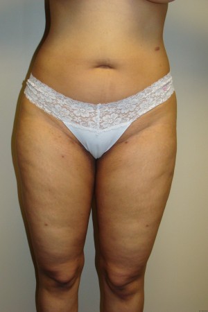 Liposuction Before and After | Grover Aesthetics