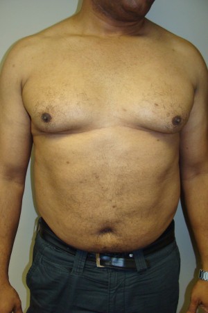 Liposuction Before and After 18 | Sanjay Grover MD FACS