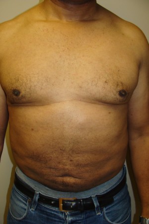 Liposuction Before and After | Grover Aesthetics