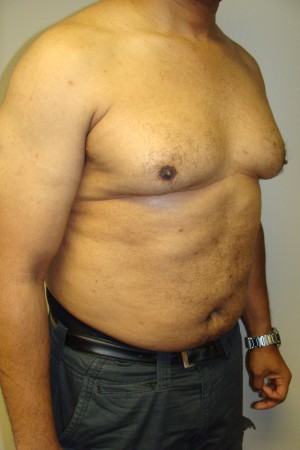 Liposuction Before and After 44 | Grover Aesthetics