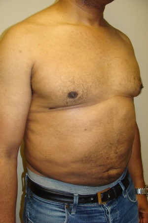 Liposuction Before and After 44 | Sanjay Grover MD FACS