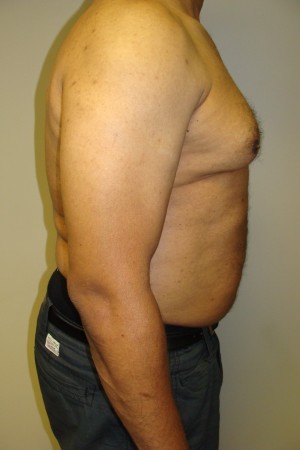 Liposuction Before and After 44 | Grover Aesthetics