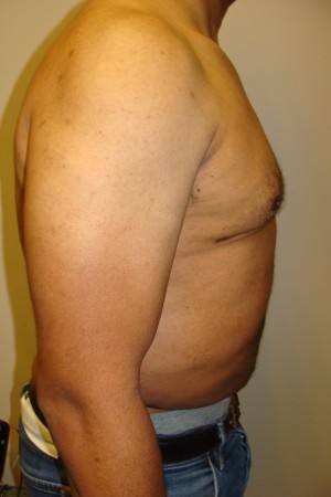 Liposuction Before and After 44 | Grover Aesthetics