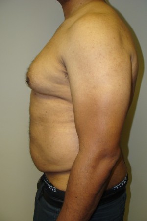 Liposuction Before and After 44 | Grover Aesthetics