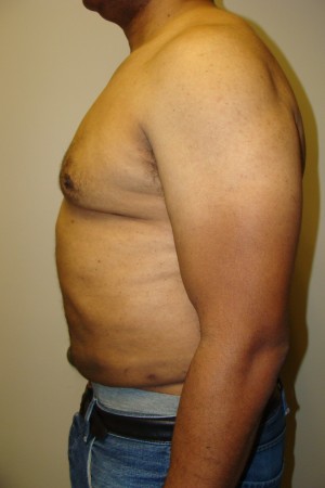 Liposuction Before and After 44 | Grover Aesthetics