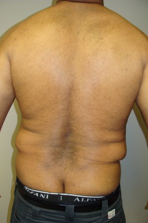 Liposuction Before and After 44 | Grover Aesthetics