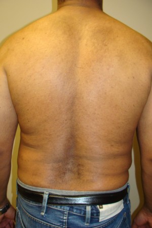 Liposuction Before and After 44 | Grover Aesthetics