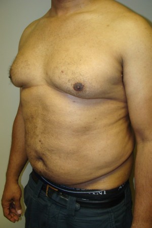 Liposuction Before and After 44 | Sanjay Grover MD FACS