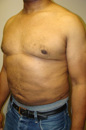 Liposuction Before and After 44 | Sanjay Grover MD FACS