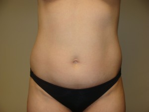 Liposuction Before and After | Grover Aesthetics