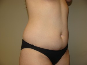 Liposuction Before and After 46 | Grover Aesthetics
