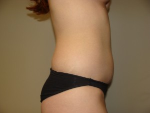 Liposuction Before and After 46 | Grover Aesthetics