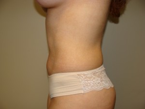 Liposuction Before and After 46 | Grover Aesthetics