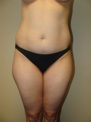 Liposuction Before and After 13 | Sanjay Grover MD FACS