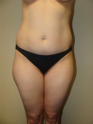 Liposuction Before and After | Grover Aesthetics