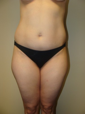 Liposuction Before and After 15 | Sanjay Grover MD FACS