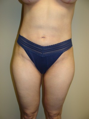 Liposuction Before and After | Grover Aesthetics