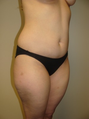 Liposuction Before and After 47 | Grover Aesthetics