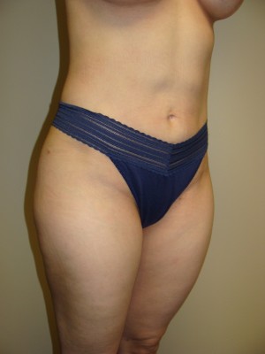 Liposuction Before and After 47 | Grover Aesthetics