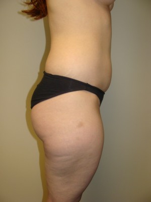 Liposuction Before and After 47 | Grover Aesthetics