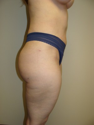 Liposuction Before and After 47 | Grover Aesthetics