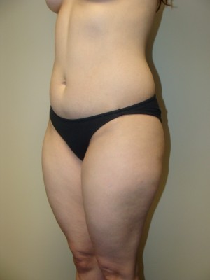 Liposuction Before and After 47 | Grover Aesthetics