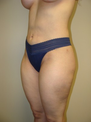 Liposuction Before and After 47 | Grover Aesthetics