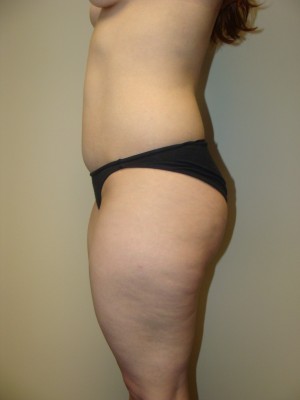 Liposuction Before and After 47 | Grover Aesthetics