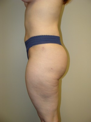 Liposuction Before and After 47 | Grover Aesthetics
