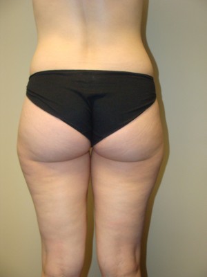 Liposuction Before and After 47 | Grover Aesthetics