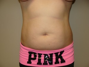 Liposuction Before and After | Grover Aesthetics