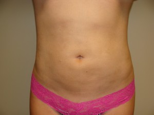 Liposuction Before and After | Grover Aesthetics