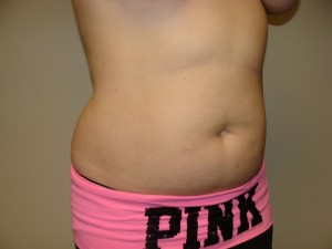 Liposuction Before and After 48 | Grover Aesthetics