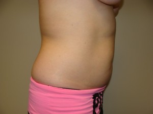 Liposuction Before and After 48 | Grover Aesthetics