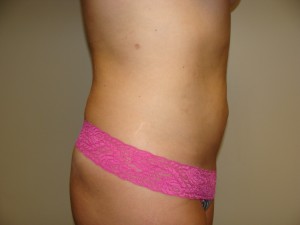 Liposuction Before and After 48 | Grover Aesthetics
