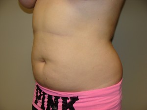Liposuction Before and After 48 | Grover Aesthetics