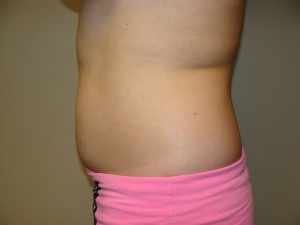 Liposuction Before and After 48 | Grover Aesthetics