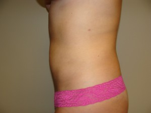 Liposuction Before and After 48 | Grover Aesthetics