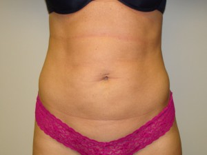 Liposuction Before and After 39 | Sanjay Grover MD FACS