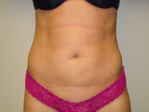 Liposuction Before and After 42 | Sanjay Grover MD FACS