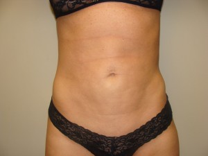 Liposuction Before and After | Grover Aesthetics