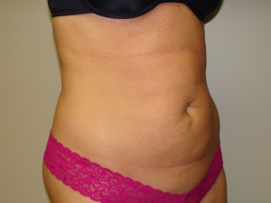 Liposuction Before and After 49 | Grover Aesthetics