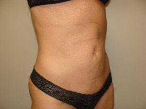 Liposuction Before and After 49 | Grover Aesthetics