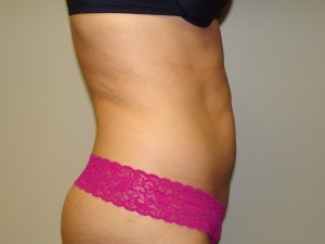 Liposuction Before and After 49 | Grover Aesthetics