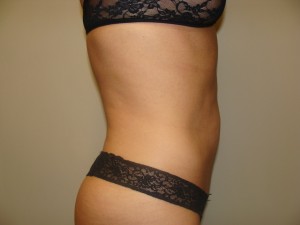 Liposuction Before and After 49 | Grover Aesthetics