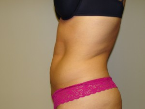 Liposuction Before and After 49 | Grover Aesthetics
