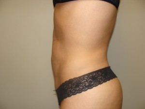 Liposuction Before and After 49 | Grover Aesthetics