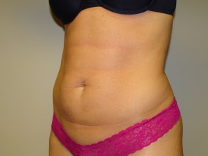 Liposuction Before and After 49 | Sanjay Grover MD FACS