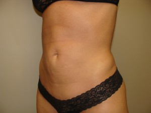 Liposuction Before and After 49 | Grover Aesthetics