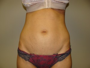 Liposuction Before and After 30 | Sanjay Grover MD FACS